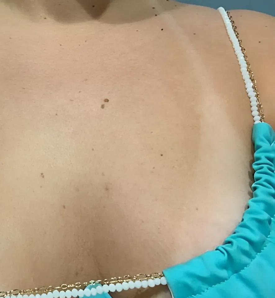 Décolleté de la même cliente, 24 heures