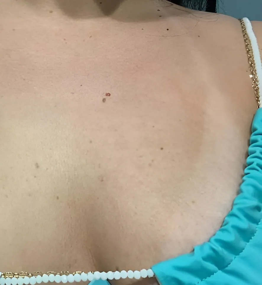 Décolleté de la même cliente, 2ᵉ jour