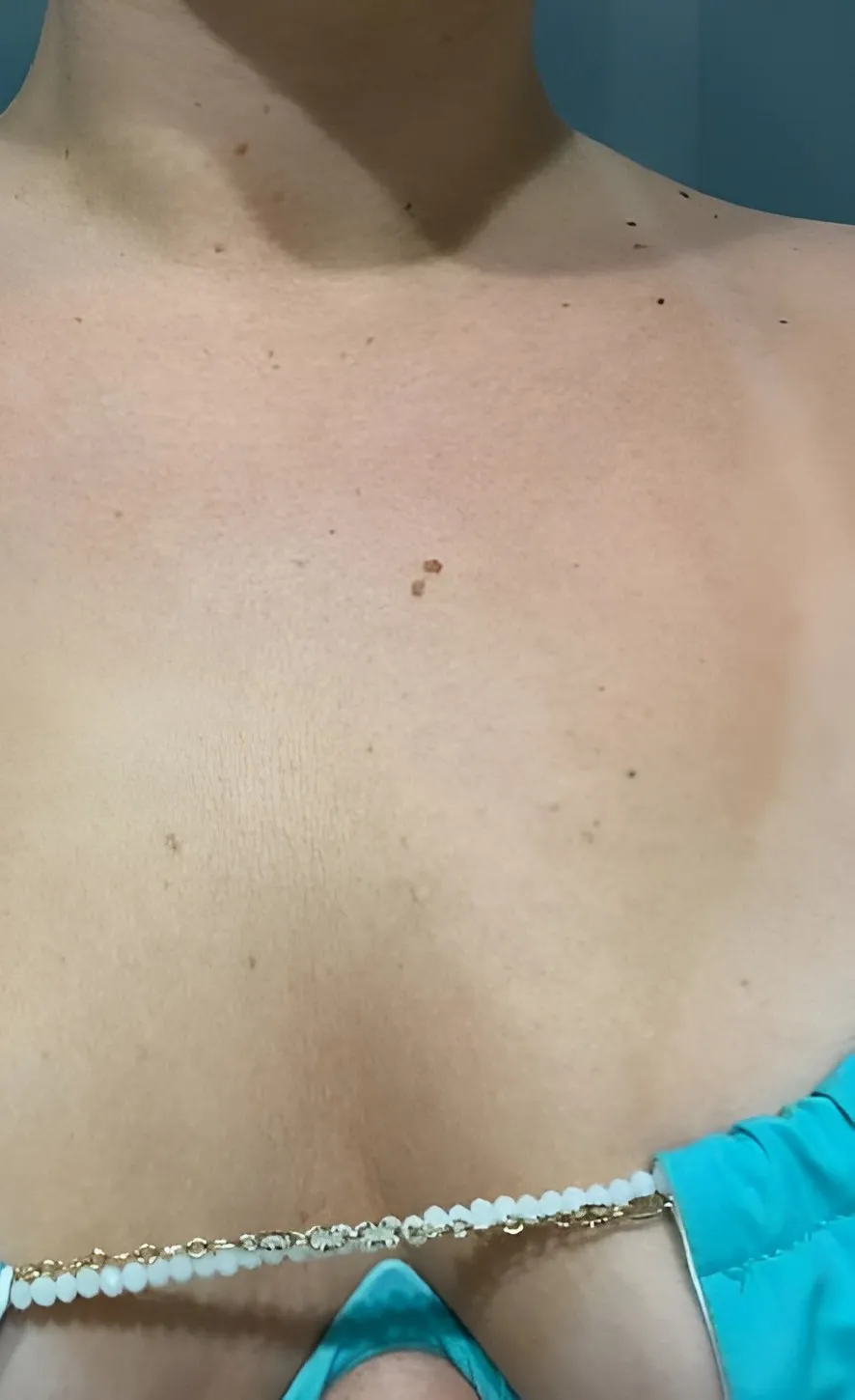 Décolleté de la même cliente, 5ᵉ jour