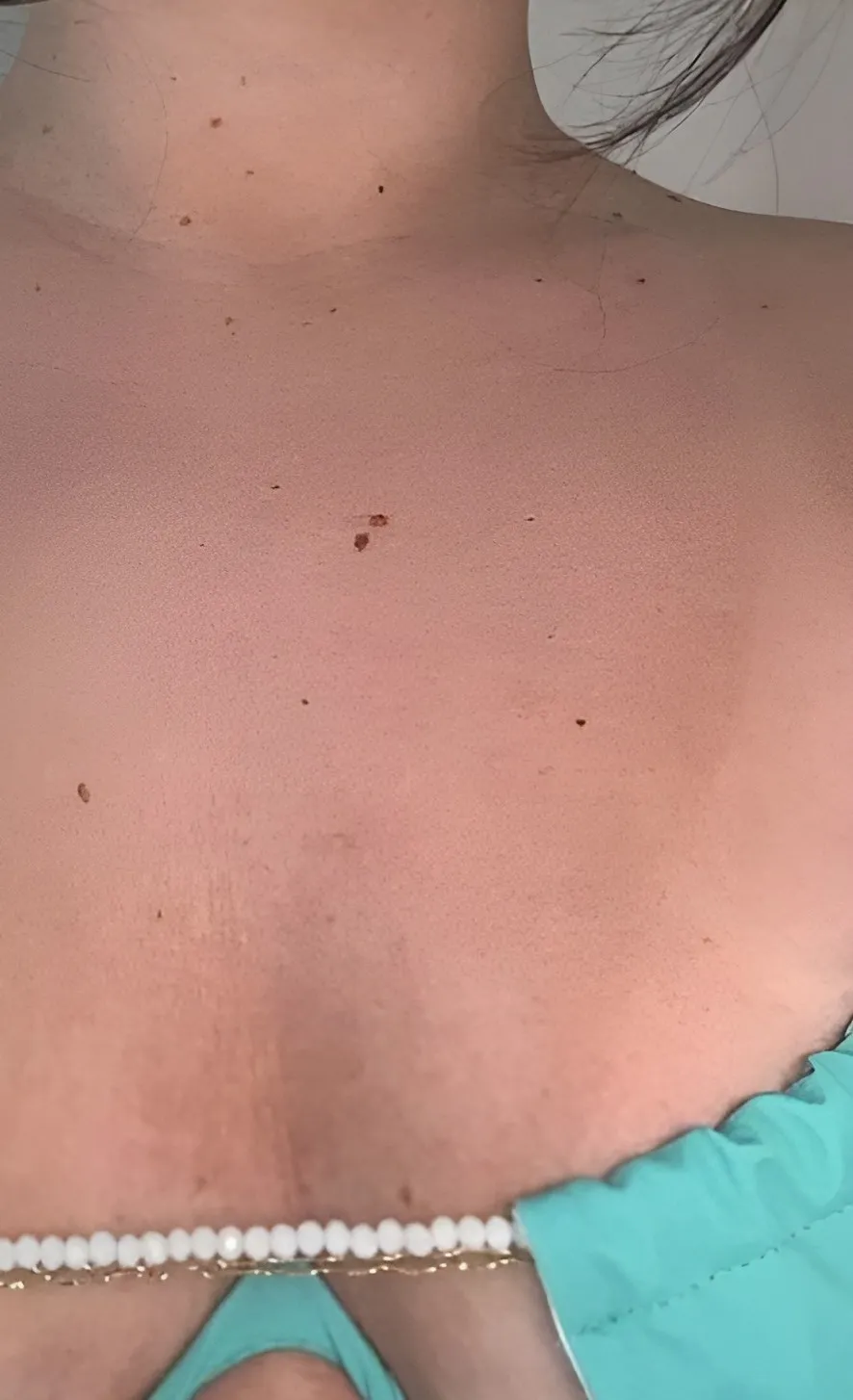 Décolleté de la même cliente, 7ᵉ jour