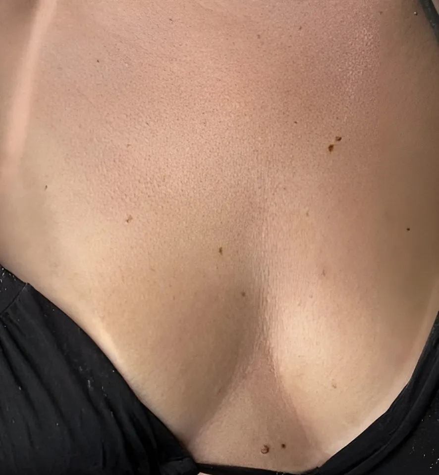 Décolleté de la même cliente, après la séance